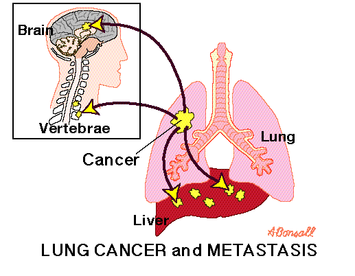 Lungcancerandmetastasis.gif