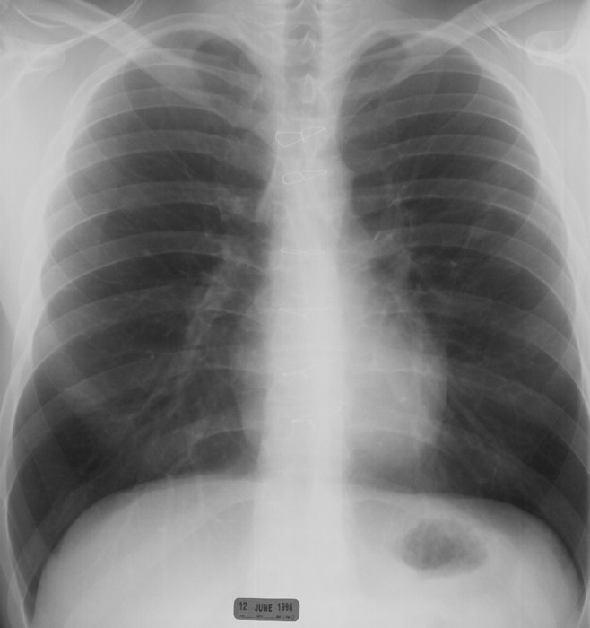 pulmones3.jpg