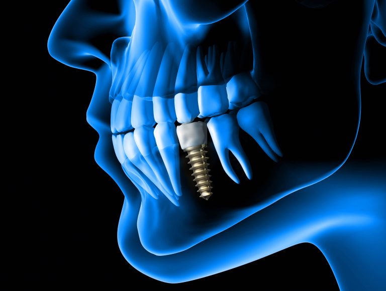 La Técnica BOPT, una técnica protésica ligada íntimamente a la periodoncia