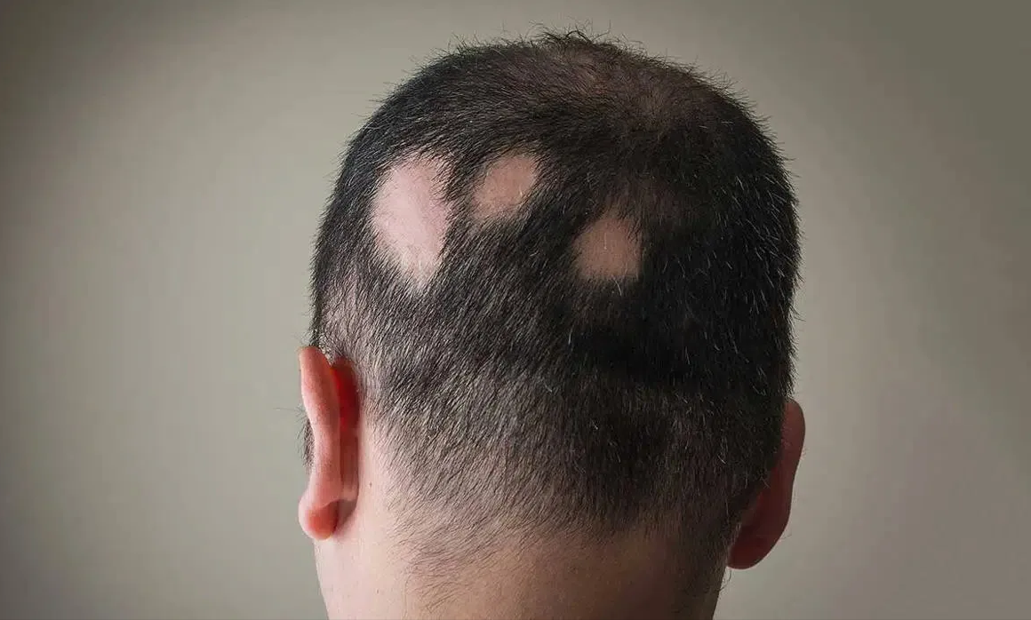 Hombre con alopecia areata
