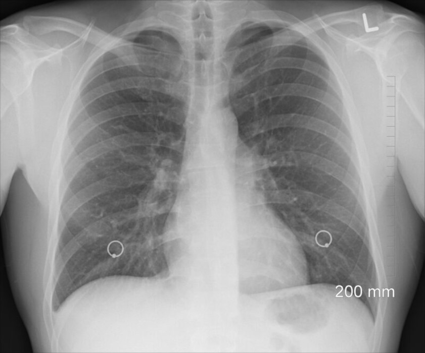 Radiografía de pulmón