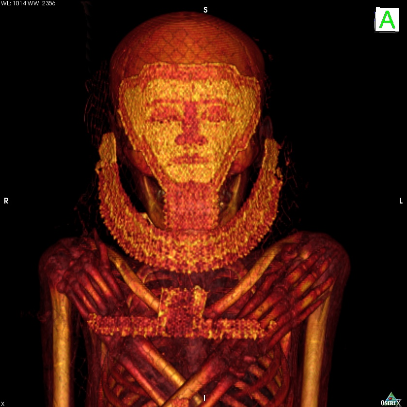 CT Scans on mummy
