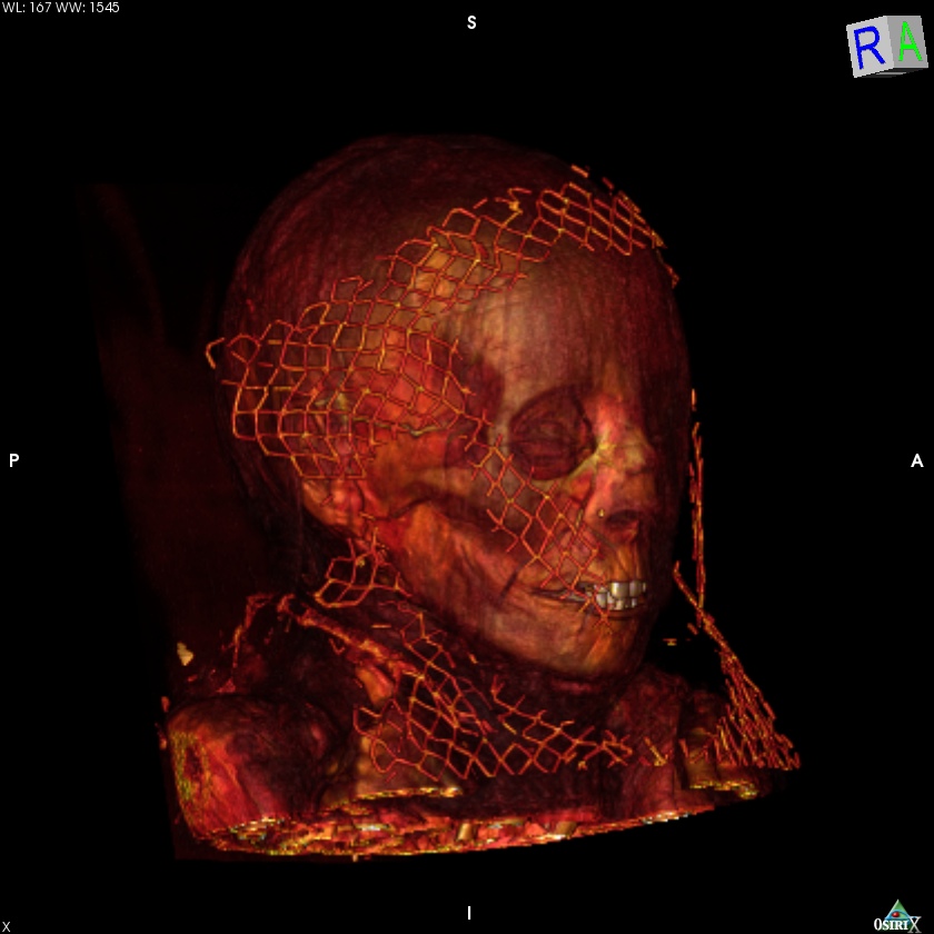 CT Scans on mummy