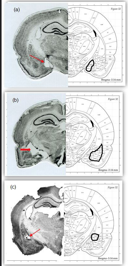 Lesions in amygdala
