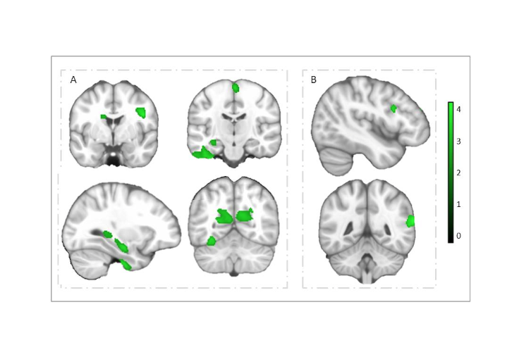 scaner de la corteza gris del cerebro