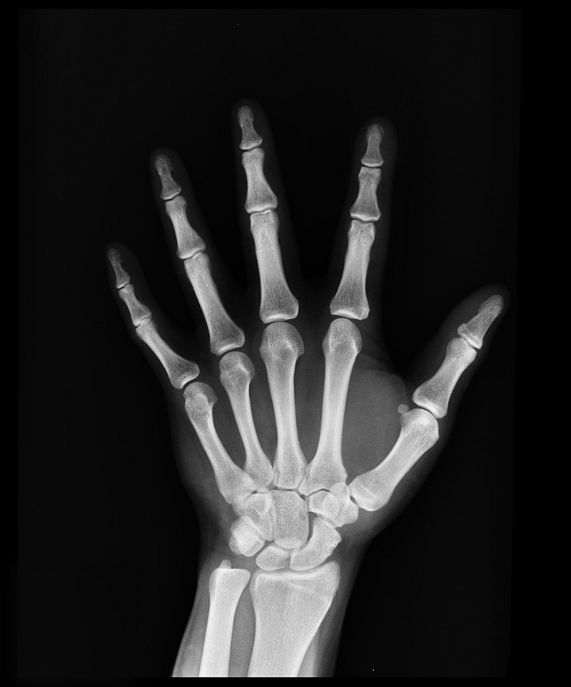 An X-ray of a hand